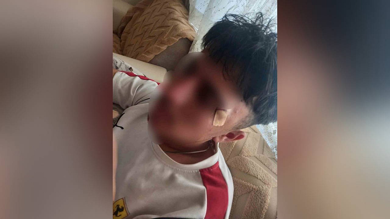 Afyonkarahisar'da öğrencinin burnu kırıldı