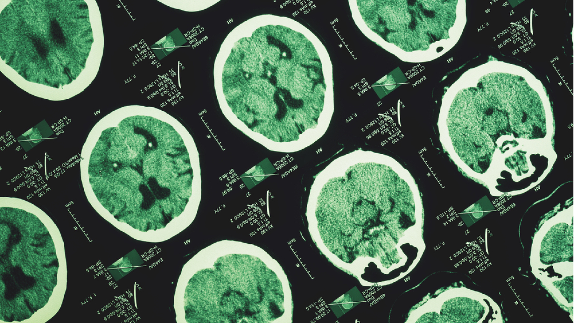 Alzheimer hastalığı unutkanlıkla başlamıyor