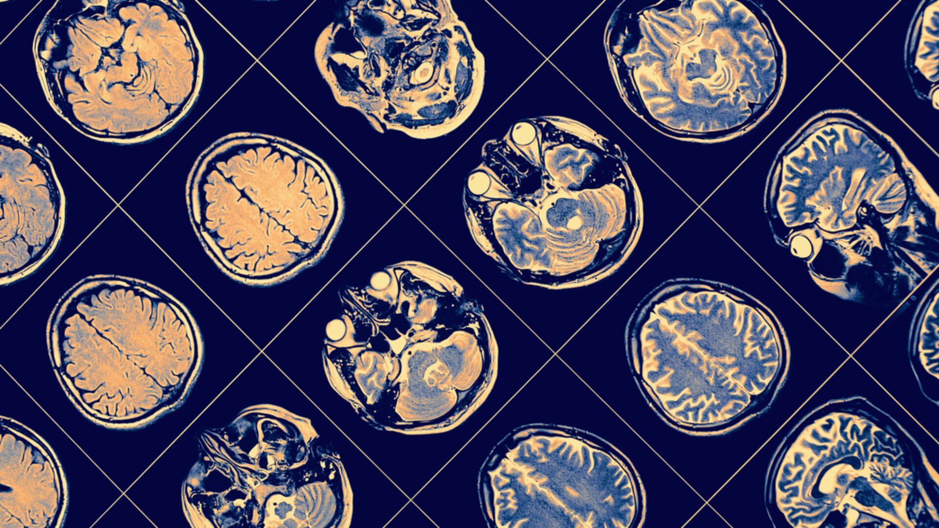 Alzheimer tanısında kan testi dönemi başladı