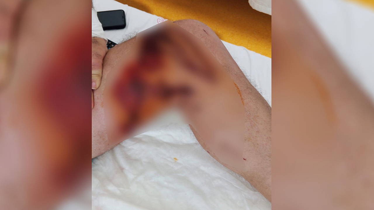 Başakşehir'de lavabo açıcı ile kaza: Yüzde 15'i yandı